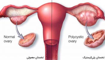 polycyctic_ffakour